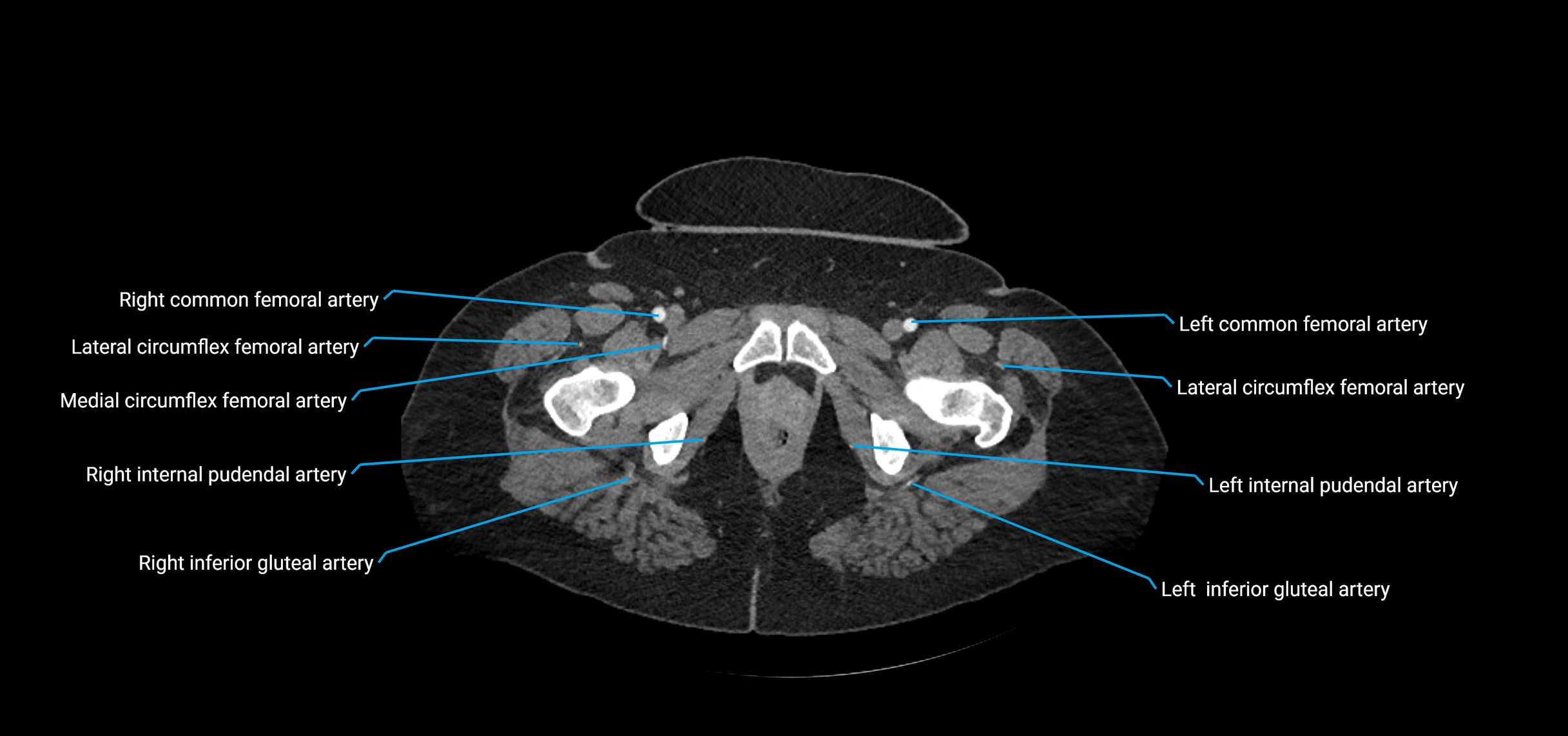 CTA abdomen axial cross sectional anatomy labelled image_264 (2).webp